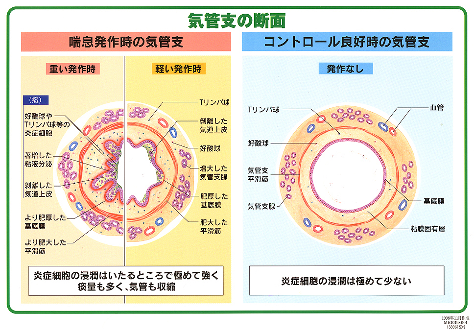 喘息の危険因子