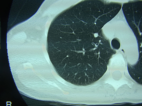 正常な肺のCT画像