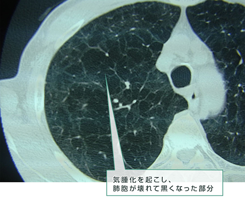 COPD患者のCT画像